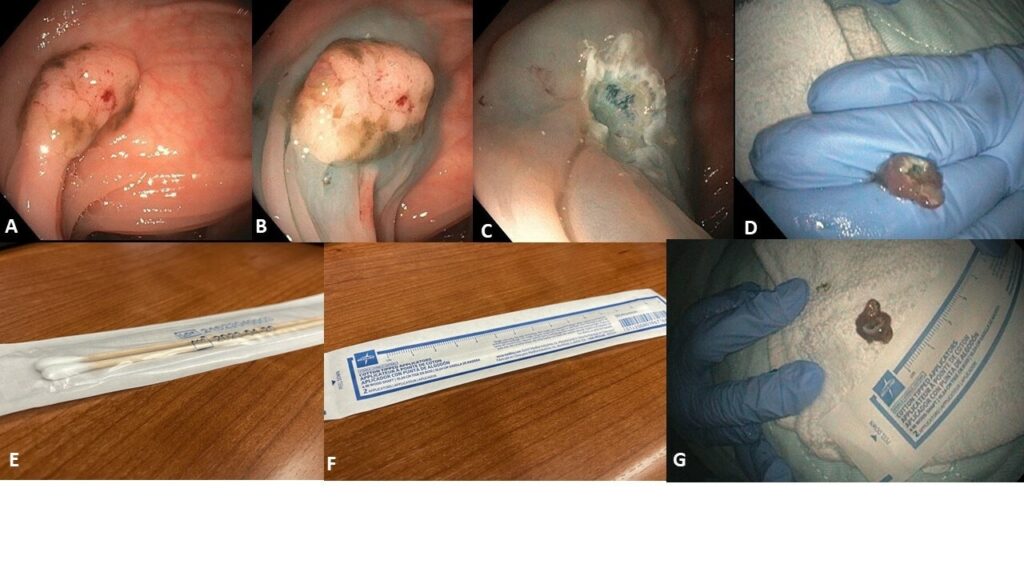 Tips for the Endoscopy Suite: Measurement of Polyp Size using the “QTip Ruler”