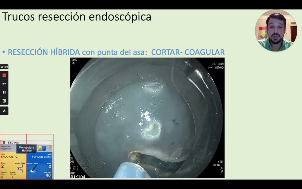 Tips Para Resección Endoscopia, Por Dr. Alvaro Martínez Alcalá 3 Tips Para Resección Endoscopia, Por Dr. Alvaro Martínez Alcalá