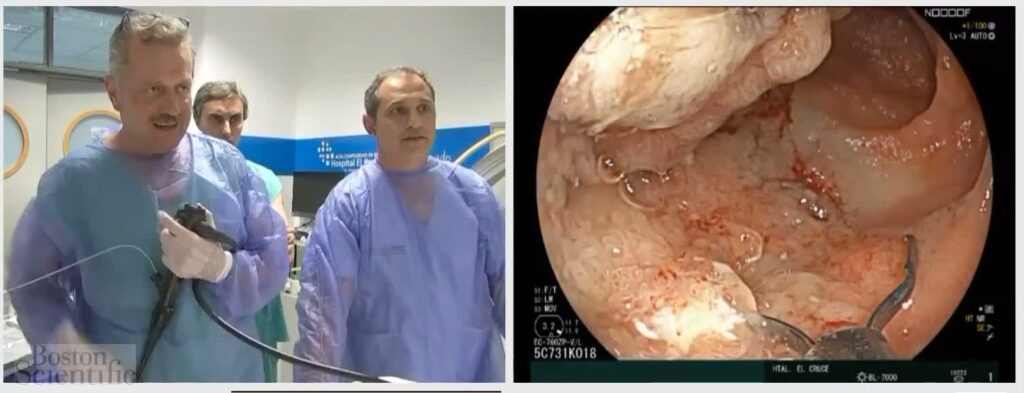 Tips Y Trucos Para Resección De Pólipos Grandes De Ileo (Peutz Jeghers) (Con Permiso: Dr. Julio De Maria Y Dr. Martin Guidi, Argentina) 8 Tips Y Trucos Para Resección De Pólipos Grandes De Ileo (Peutz Jeghers) (Con Permiso: Dr. Julio De Maria Y Dr. Martin Guidi, Argentina)