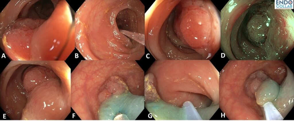Top Tips For Dealing With A Colon Polyp In A Difficult Situation
