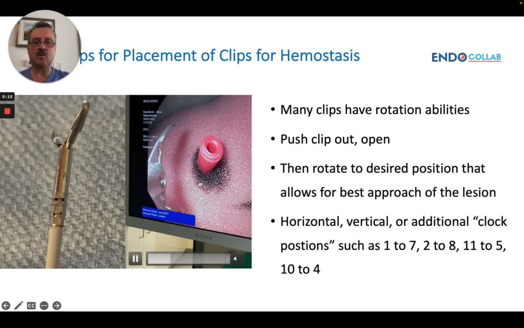 Top Tips For Placing Clips For Hemostasis