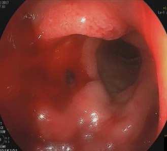 Torrential (Forrest I A) Duodenal Bulb Ulcer Bleeding