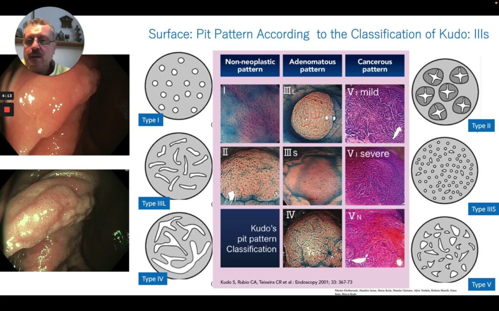 Train Your Eye To Detect And Characterize Colon Polyps 7 Train Your Eye To Detect And Characterize Colon Polyps