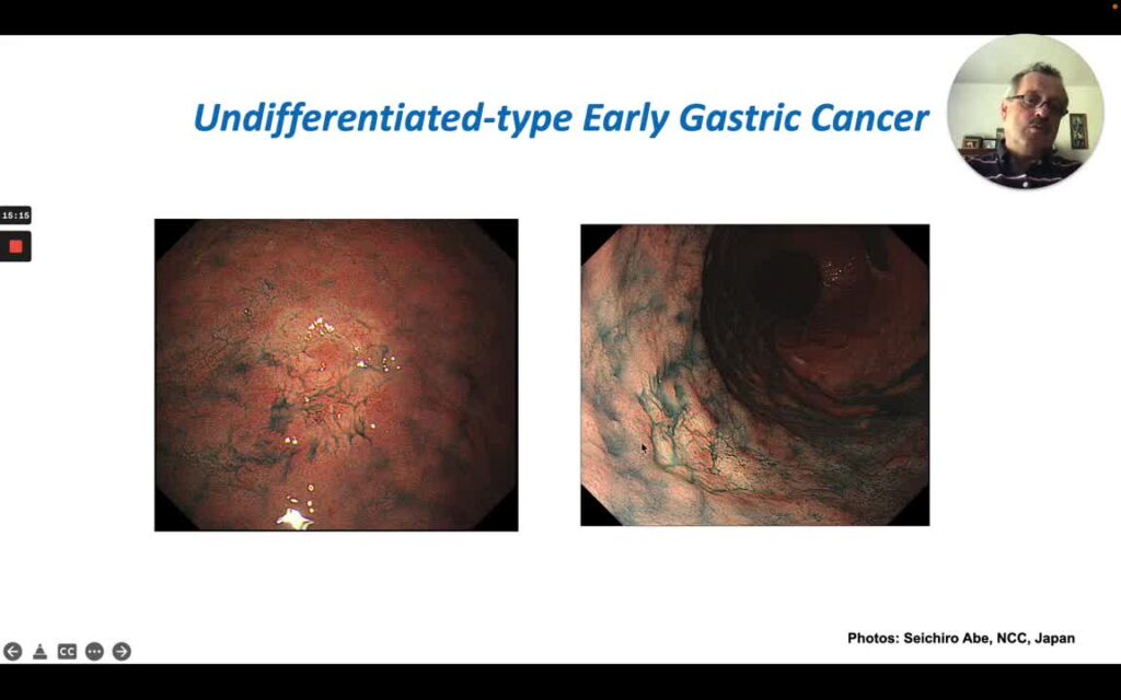 Train Your Eye To Detect Early Gastric Cancer
