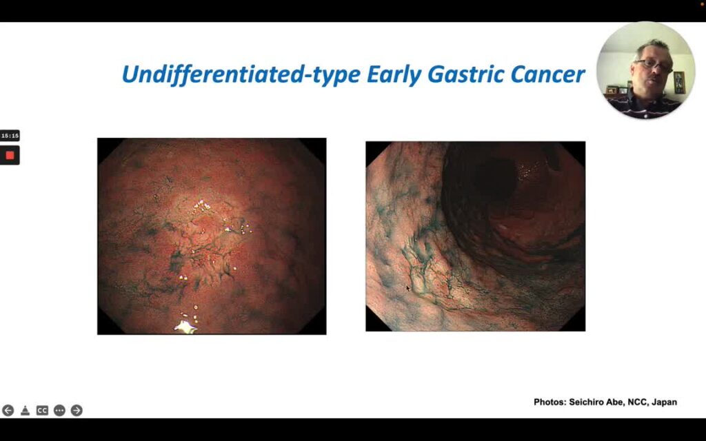 Train Your Eyes To Detect Early Gastric Cancer