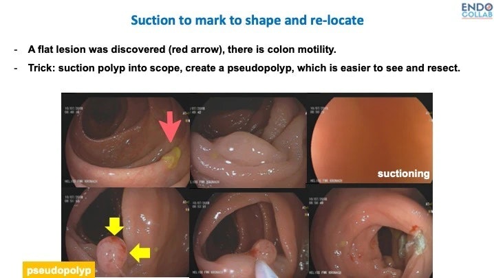 Trick To Find Polyp Again -Suction To Mark And Relocate