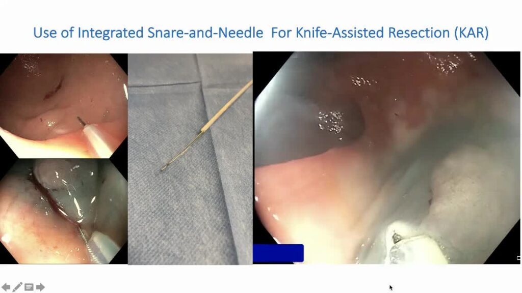 Two-in-One Needle-Snare Device โ Endoscopic Knife-Assisted Resection (KAR)