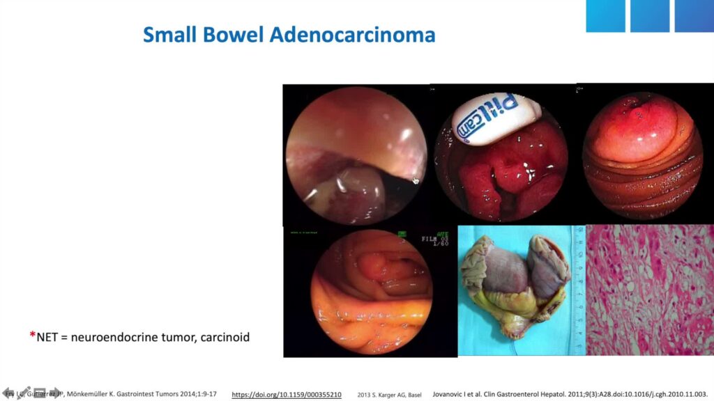 Ulcerative Diseases of the Small Bowel