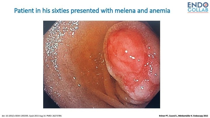 Unusual Ulcerated Polyp In The Duodenum