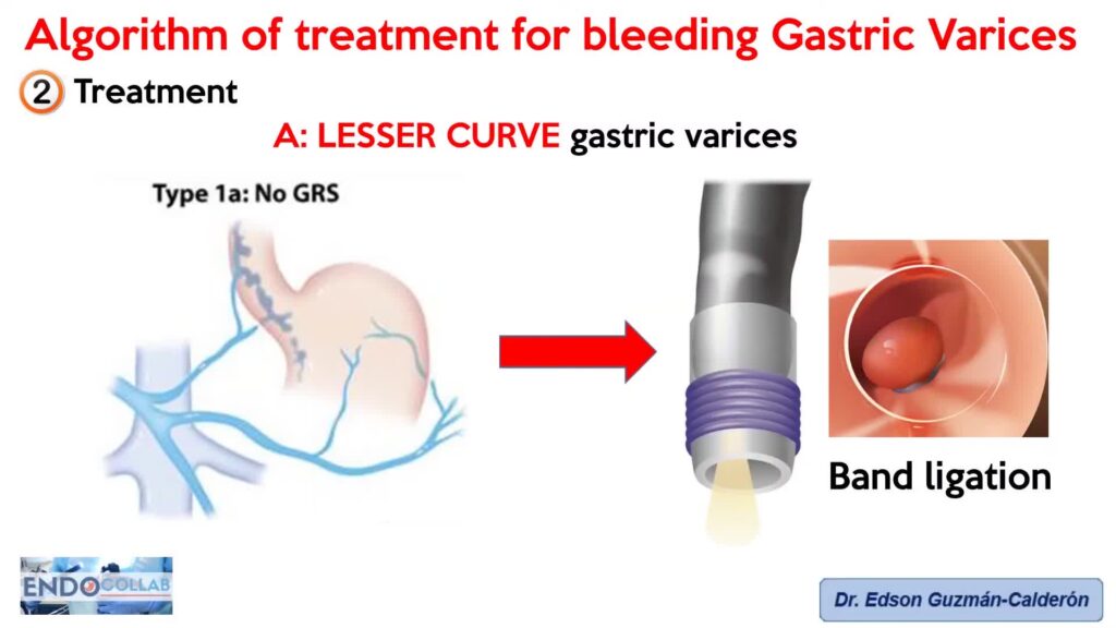 Algorithm Of Treatment For Bleeding Gastric Varices By Edson Guzman Calderon 11 Algorithm Of Treatment For Bleeding Gastric Varices By Edson Guzman Calderon