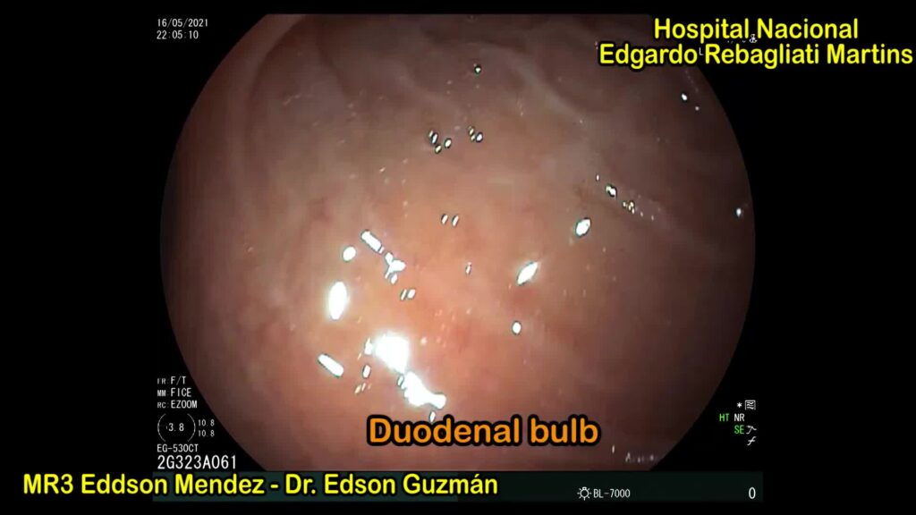 Large Gastric Ulcer Penetrated To Duodenal Bulb With Gastroduodenal Fistula 2 Large Gastric Ulcer Penetrated To Duodenal Bulb With Gastroduodenal Fistula