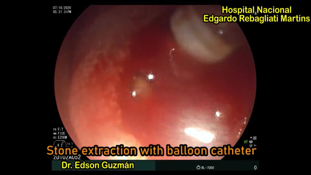 Management Of Persistent Post-Sphincterotomy Bleeding By Edson Guzman Calderon 4 Management Of Persistent Post-Sphincterotomy Bleeding By Edson Guzman Calderon