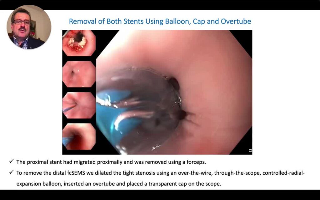 Use Of Cap-Assisted Endoscopy, Overtube And Dilation Balloon To Remove Migrated Esophageal Sems