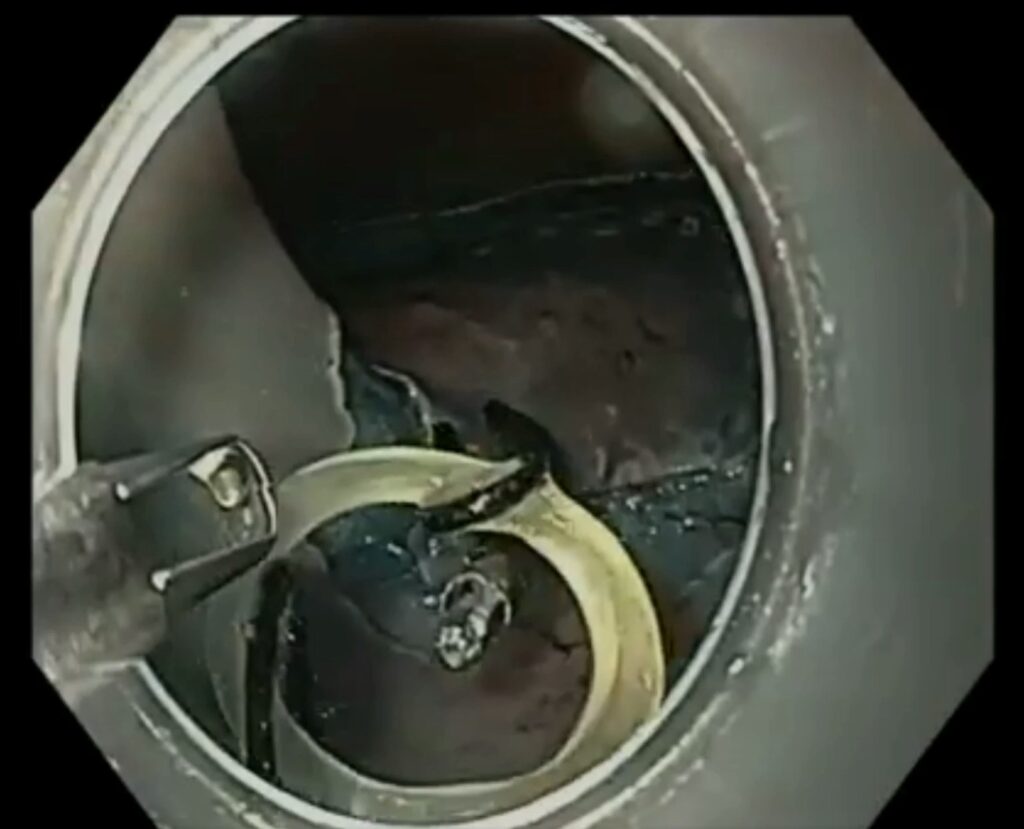 Use Of Traction Methods For Endoscopic Resection , Including The Esge Technical Review By Dr. Antonio Rodriguez