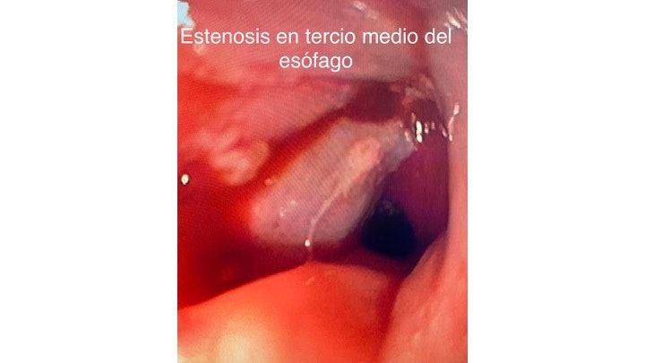 Usefulness Of Fcsems To Bridge Stenosis And Cover Esophagotracheal Fistula By Dr Rafael Bernal Méndez