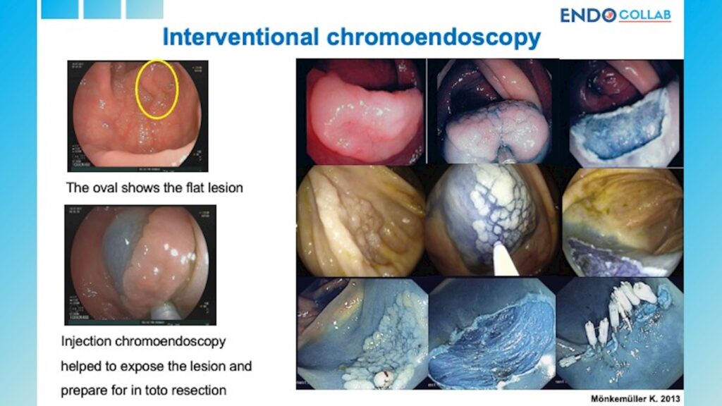 Usefulness Of Interventional Chromoendoscopy To Improve Polyp Visualization 5 Usefulness Of Interventional Chromoendoscopy To Improve Polyp Visualization
