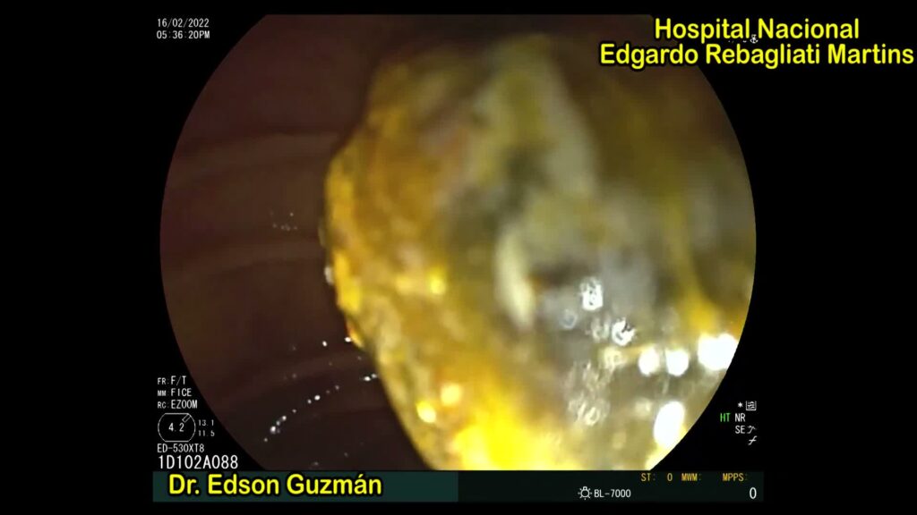 Usefulness Of Mechanical Lithotripsy In Cholangioscopy Times 7 Usefulness Of Mechanical Lithotripsy In Cholangioscopy Times