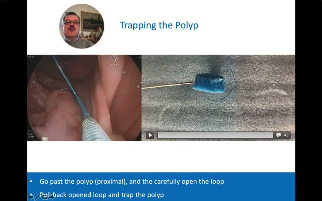 Using Endoloop Before Resecting A Thick-Stalked 0-Ip Polyp