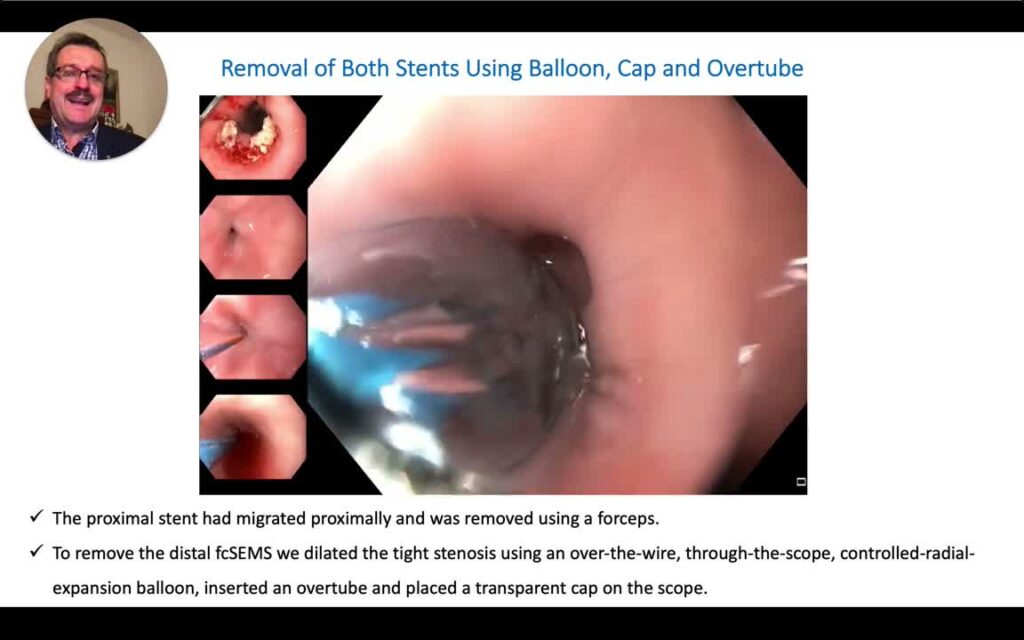 Using Overtube to Remove Distally Migrated Esophageal Stent