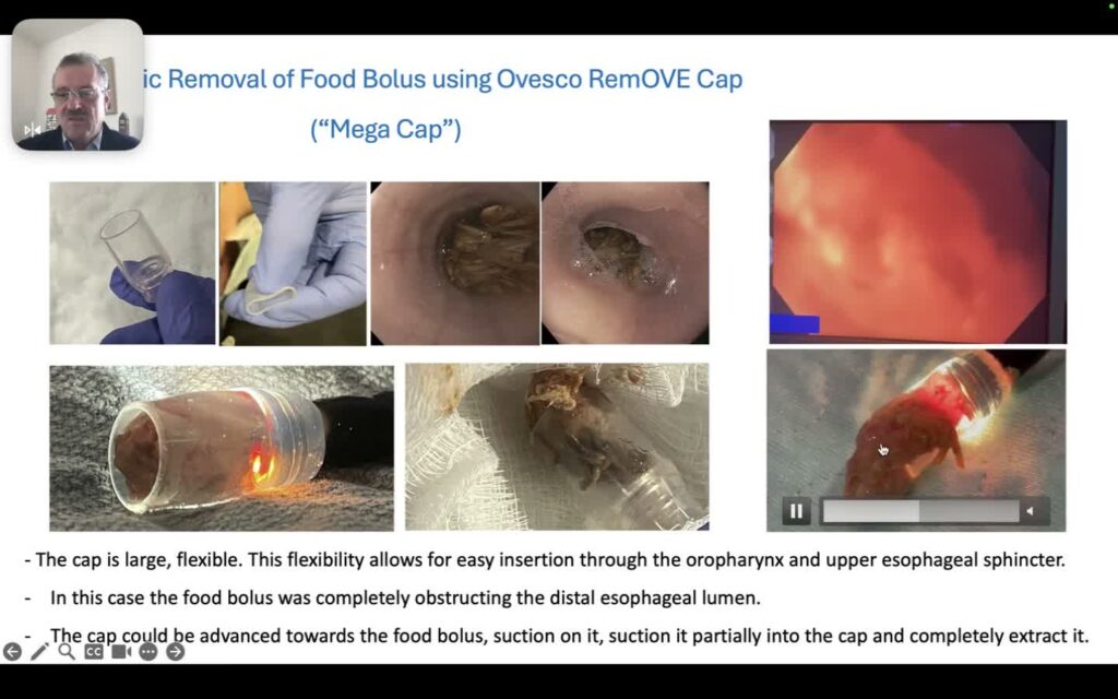 Using the Mega Cap (RemOVE) to Remove Meat Impaction and Foreign Bodies