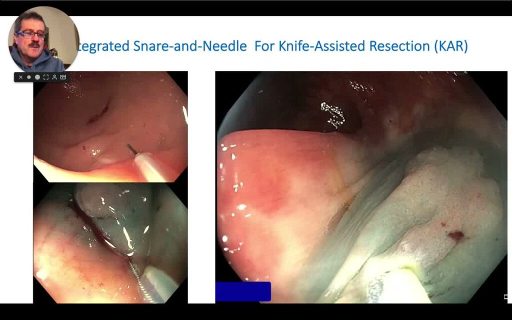 Uso De La “Isnare” (Asa Con Inyector Integrado) Para Resección Híbrida (“Knife-Assisted Resection”)