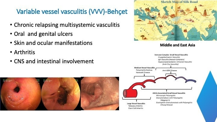 Variable Vessel Vasculitis (Behcet'S Disease) 1 Variable Vessel Vasculitis (Behcet’s Disease)