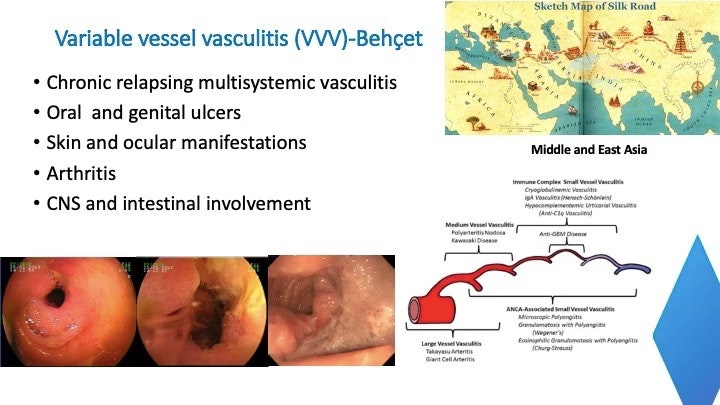 Variable Vessel Vasculitis (Behcet'S Disease) 3 Variable Vessel Vasculitis (Behcet’s Disease)