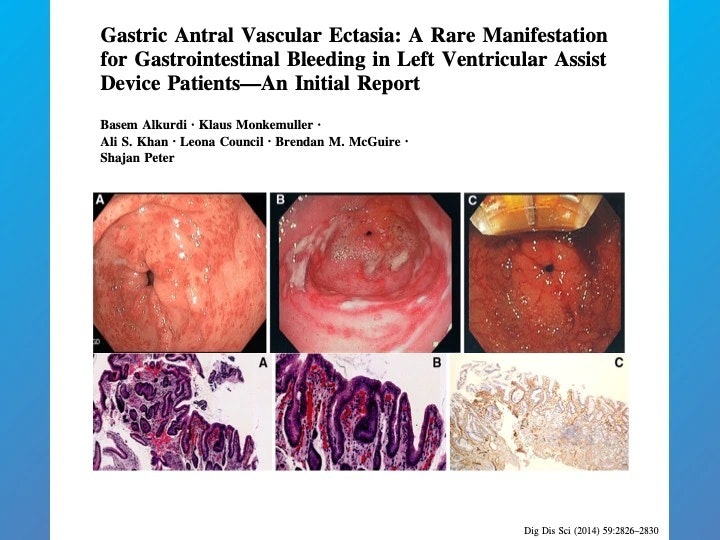 What Are The Etiologies Of Watermelon Stomach (Gave, Gastric Antral Vascular Ectasia)?