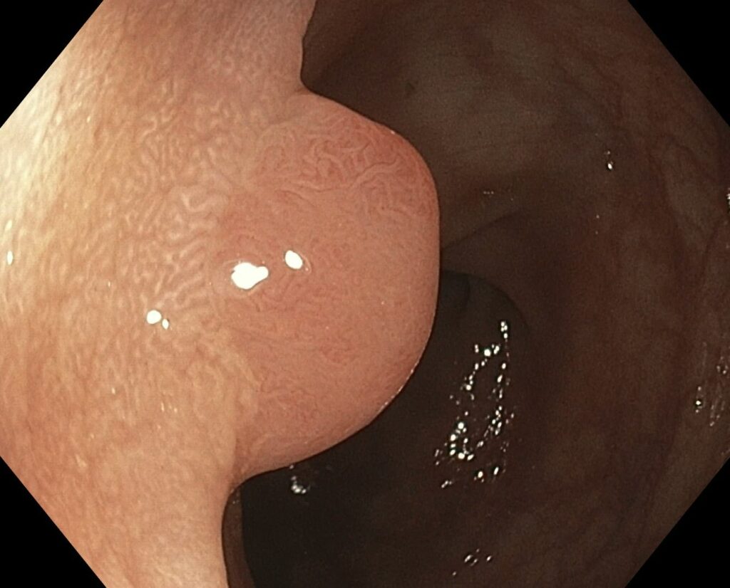 What Is This Whitish Mucosa Called Around These Polyps?