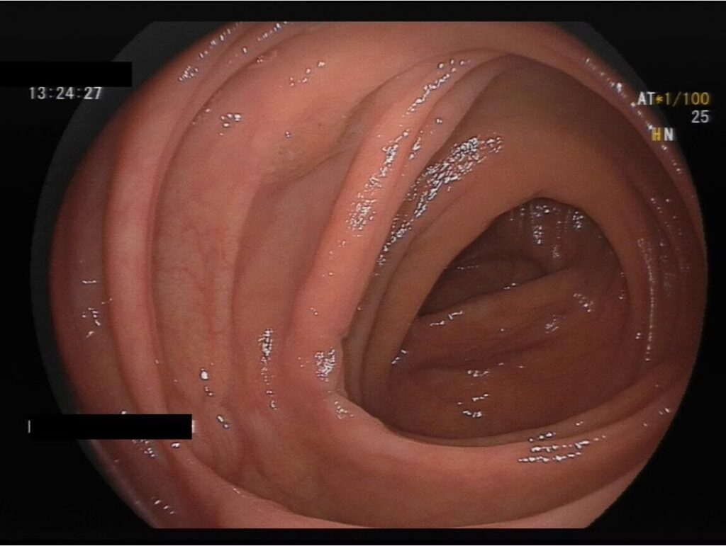Where Is The Polyp? What Findings Helped You Find The Lesion? What Would You Do To Better Define This Polyp? 3 Where Is The Polyp? What Findings Helped You Find The Lesion? What Would You Do To Better Define This Polyp?