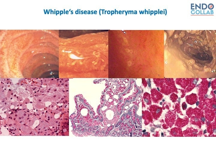 Whipple Disease 1 Whipple Disease