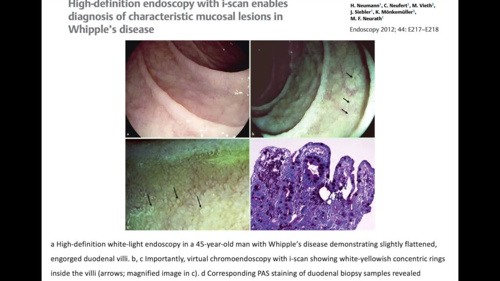 Whipple Disease For The Endoscopist 5 Whipple Disease For The Endoscopist