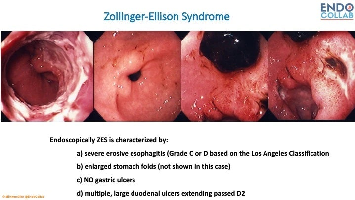 Zollinger Ellison Syndrome (Gastrinoma)
