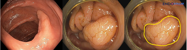 Gi Endoscopy Community &Amp; Education - Endocollab 1 Serrated Colon Lesion Showing Diffuse Aceto-Whitening After 2.5% Acetic Acid Chromoendoscopy