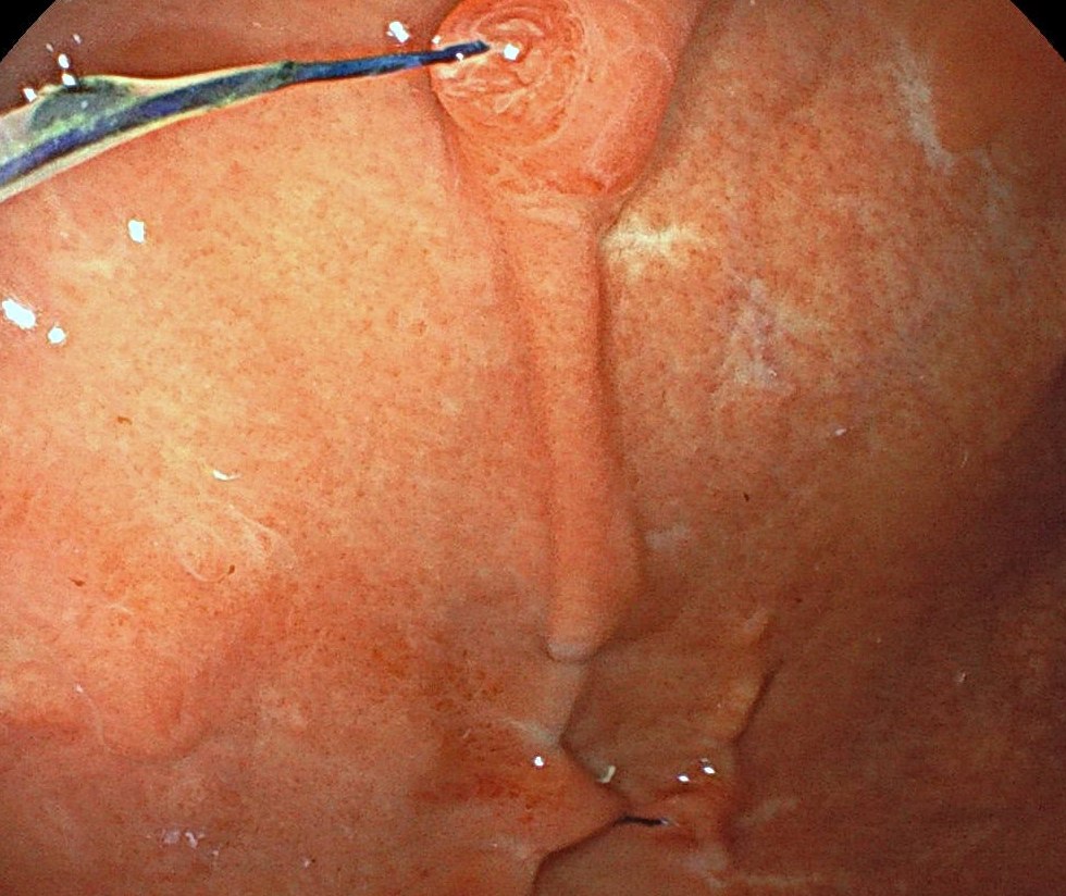 Gi Endoscopy Community &Amp; Education - Endocollab