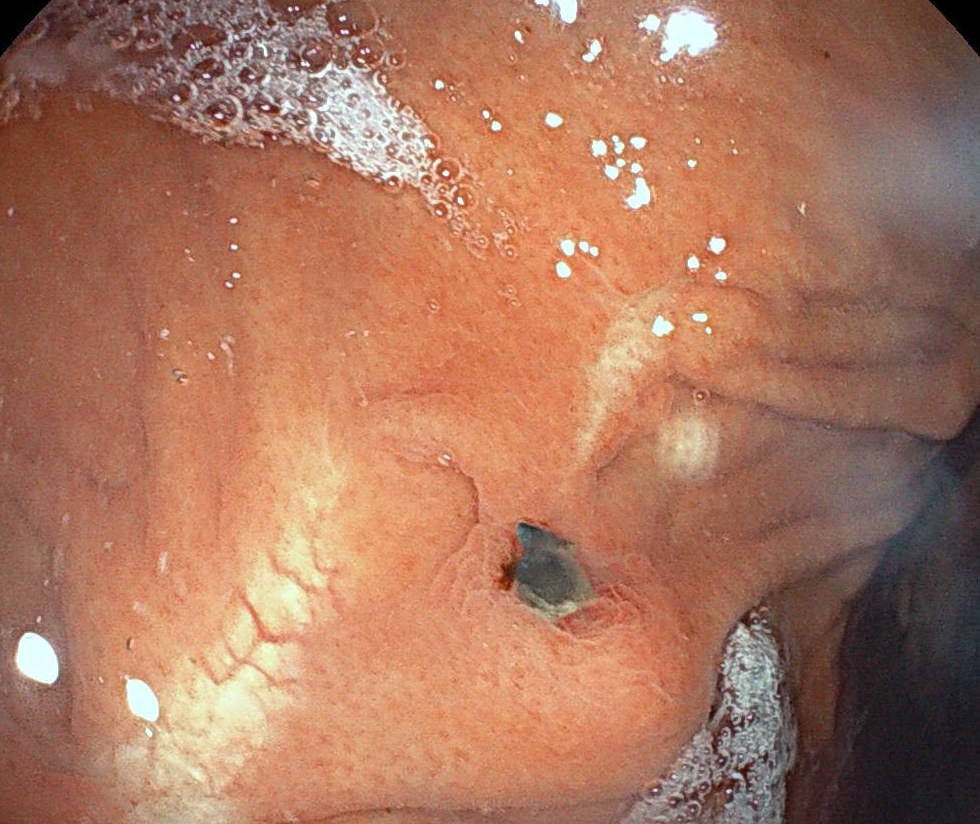 Exposed Suture Sitting In A Small Mucosal Pocket With Surrounding Gastric Folds