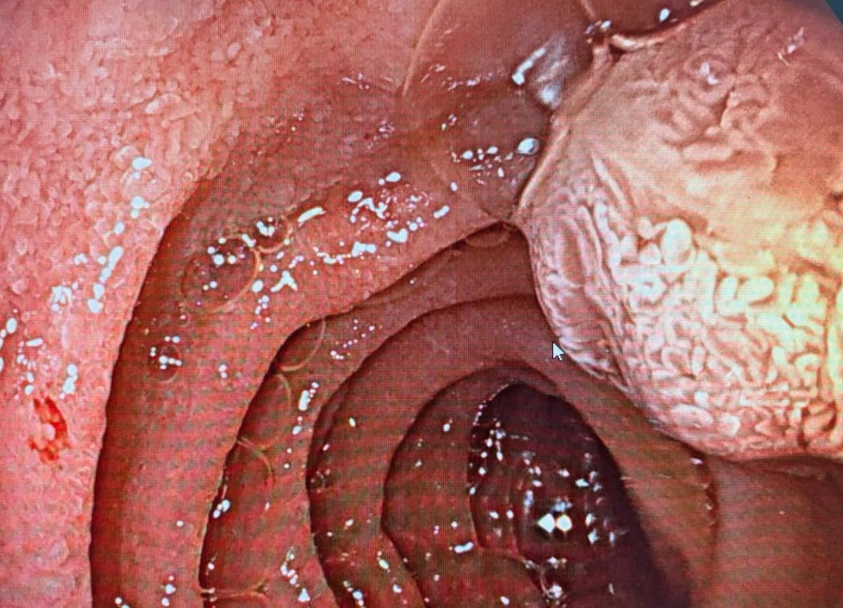 Close View Of A Cerebriform Polypoid Lesion On A Duodenal Fold Beside The Lumen
