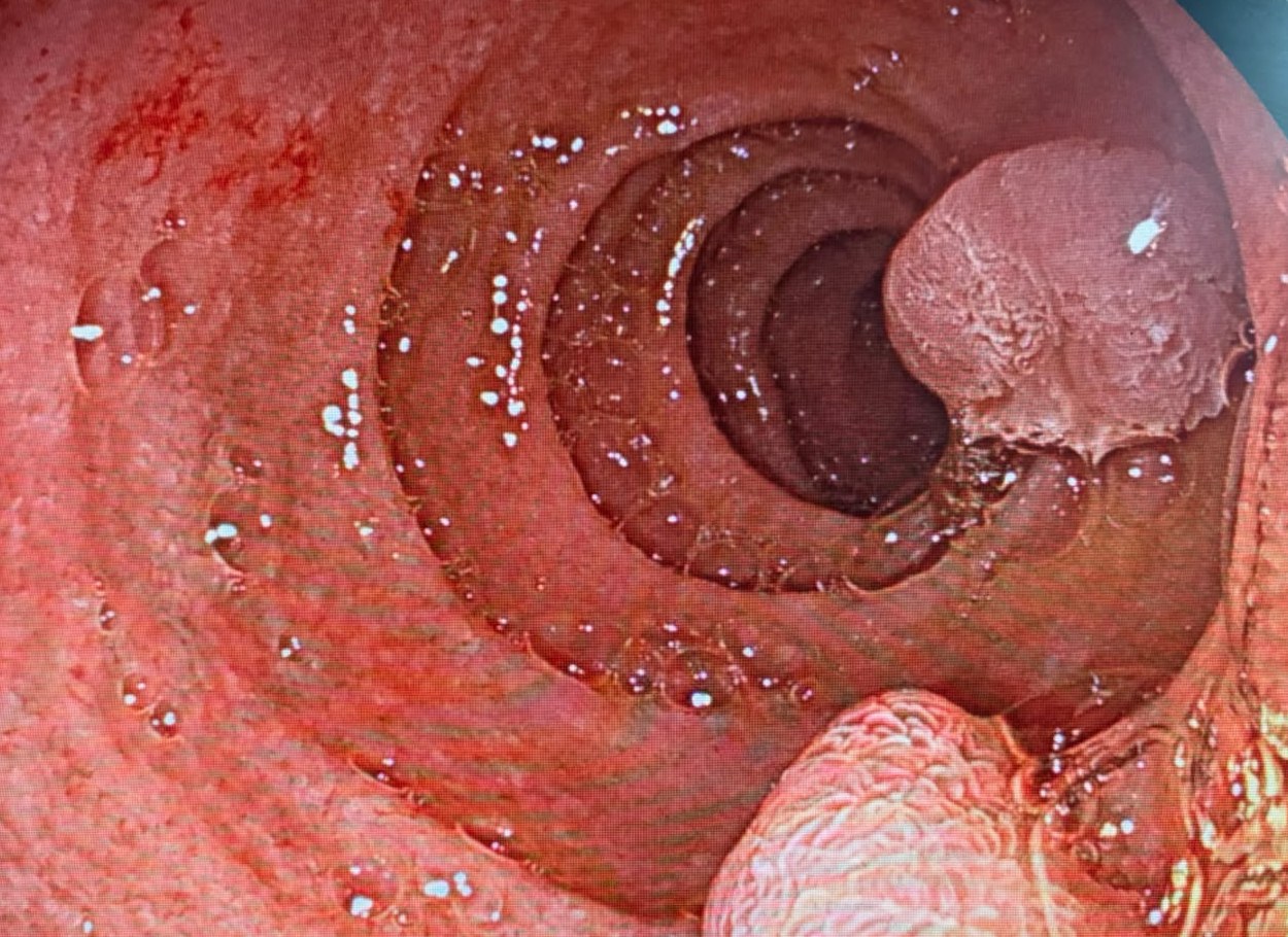 Two Polypoid Duodenal Lesions, One Smooth And Proximal, One Cerebriform And Closer To The Lens
