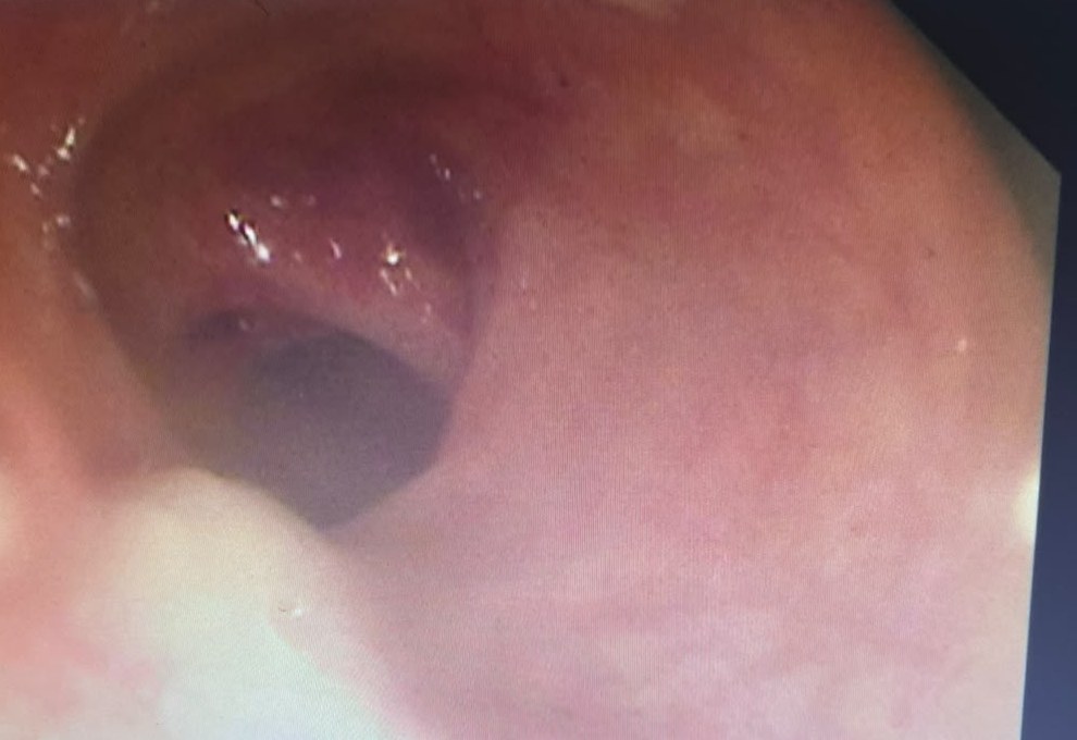 Erythematous Colonic Lumen With Loss Of A Normal Vascular Pattern, Photographed From A Monitor