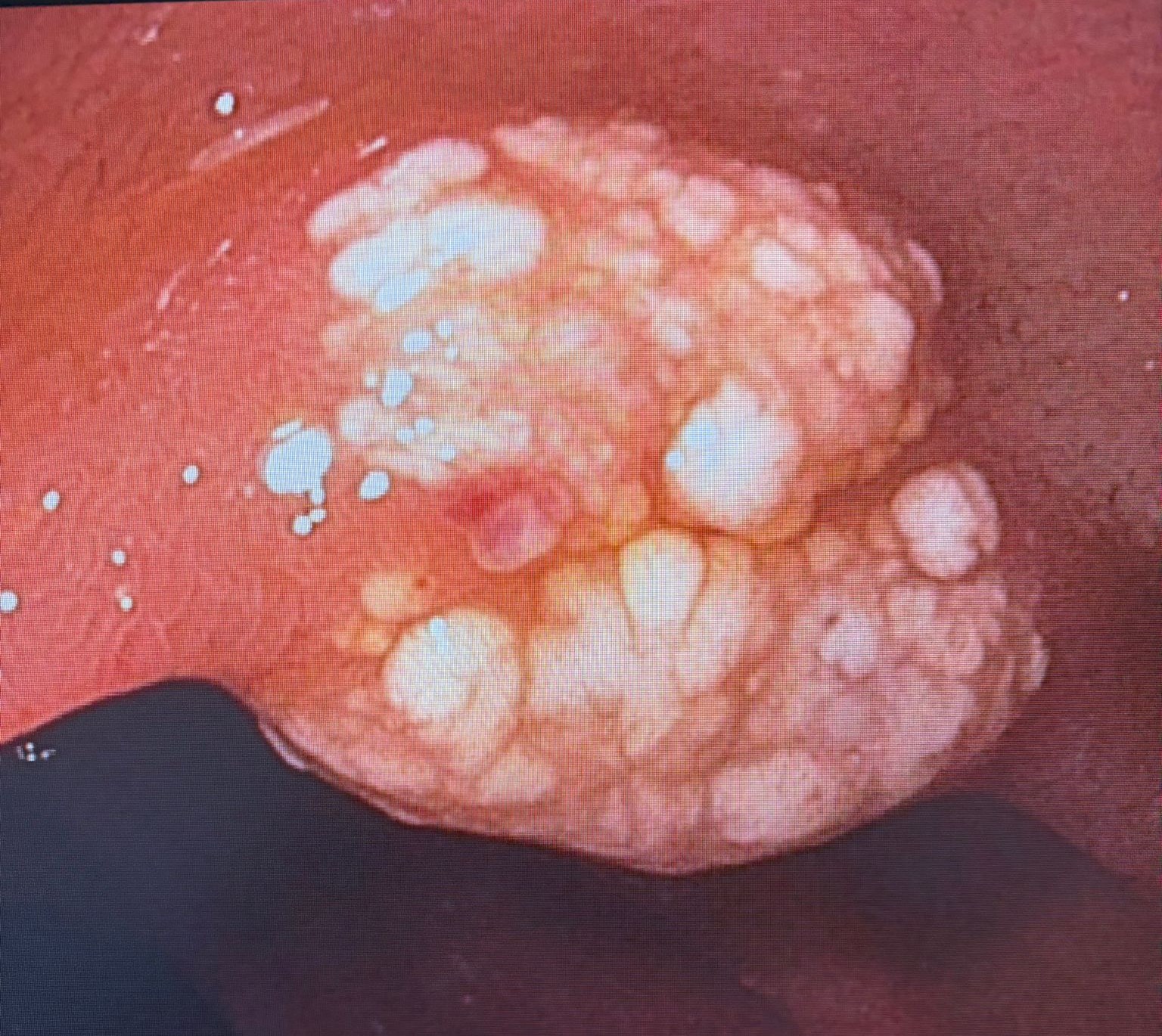 Pale Yellow Nodular Lesion With A Mammillated Surface On Duodenal Mucosa