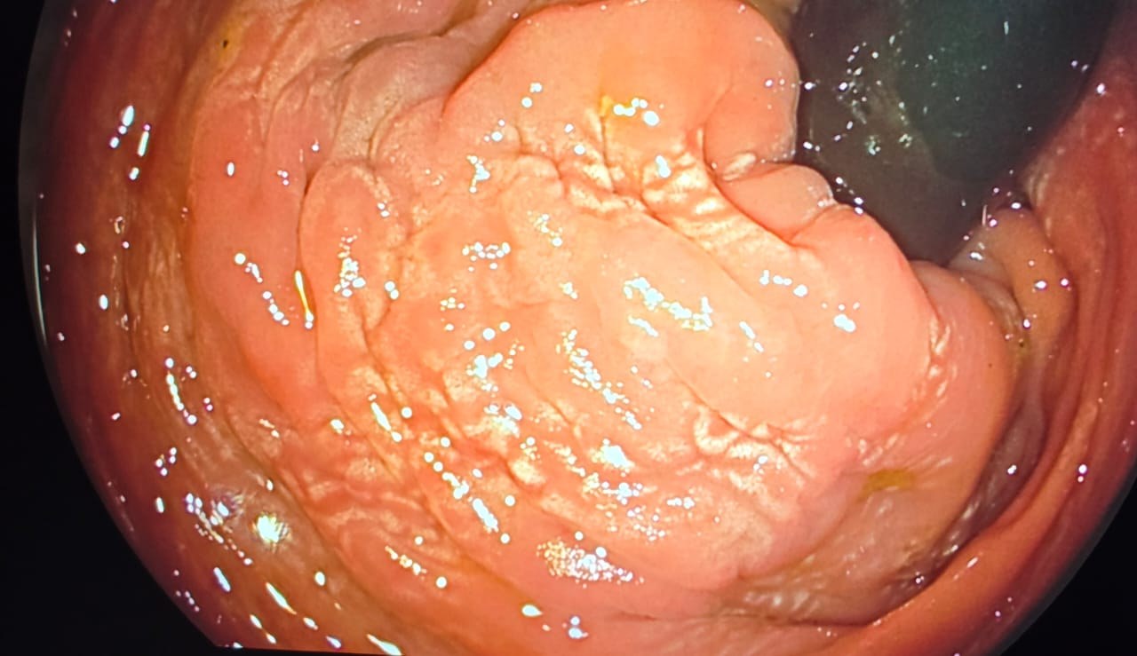 Close Endoscopic View Of Pink Rectal Folds With A Pale Vascular Pattern And No Ulcer