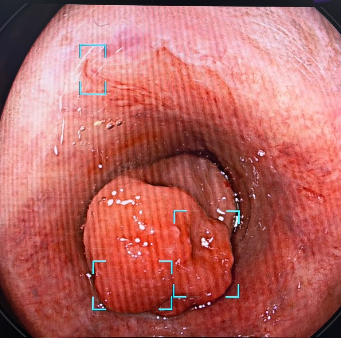 Polypoid Erythematous Lesion On The Anterior Rectal Wall With Detection Boxes Overlaid By The Endoscope