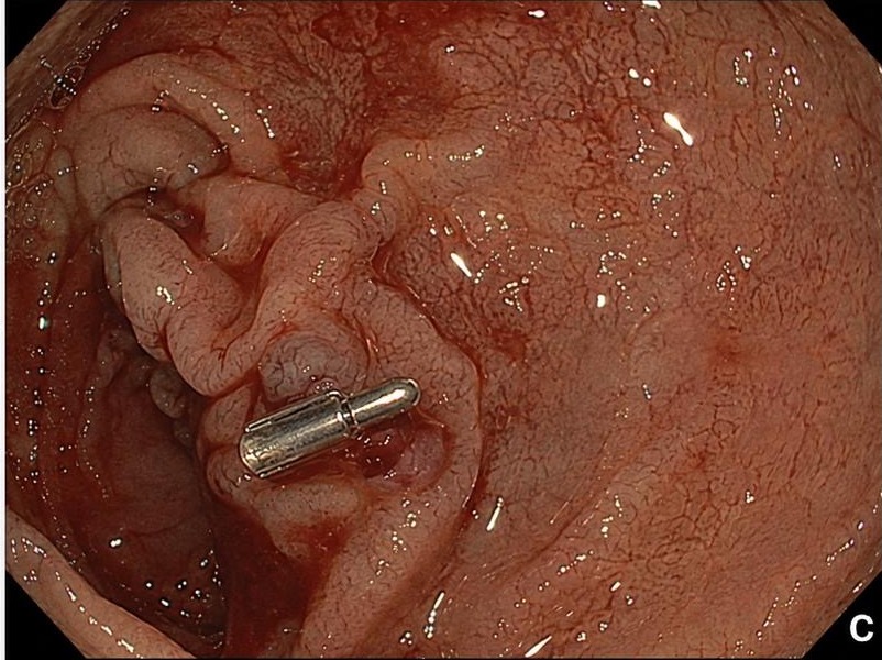 Gi Endoscopy Community &Amp; Education - Endocollab