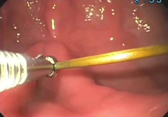 Rat-Tooth Forceps Grasping Metal Foreign Body With Scope Torque