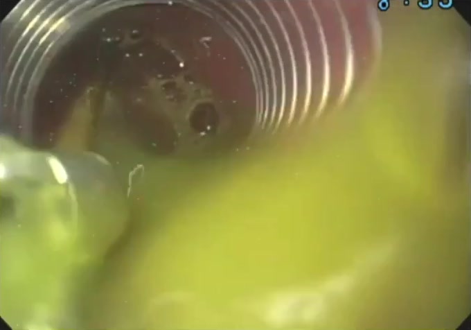 Assistant Pushing Overtube Down During Scope Withdrawal With Foreign Body