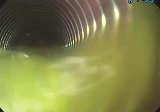 Foreign Body Fully Housed Inside Overtube Before Final Extraction