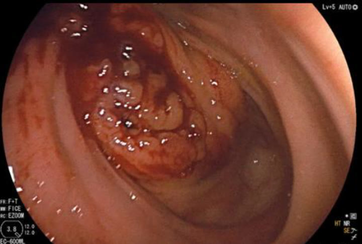Gi Endoscopy Community &Amp; Education - Endocollab 1 Gi Endoscopy Community &Amp; Education - Endocollab