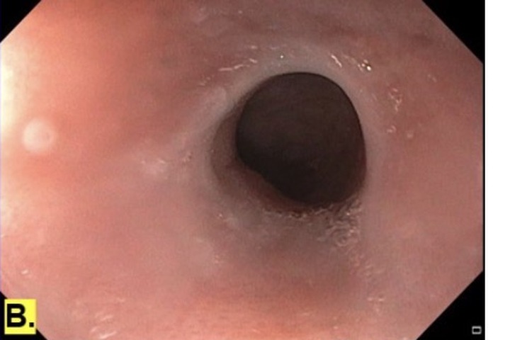 Gi Endoscopy Community &Amp; Education - Endocollab