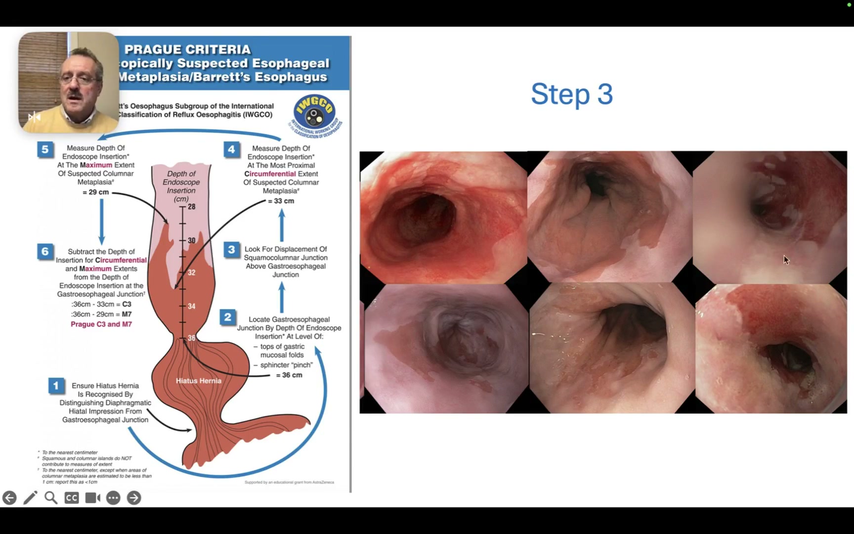 Prague C And M: A 7-Minute Barrett Length Guide 1 Iwgco Prague Criteria Slide On Step 3: Look For Tongues And Proximal Z-Line Shift