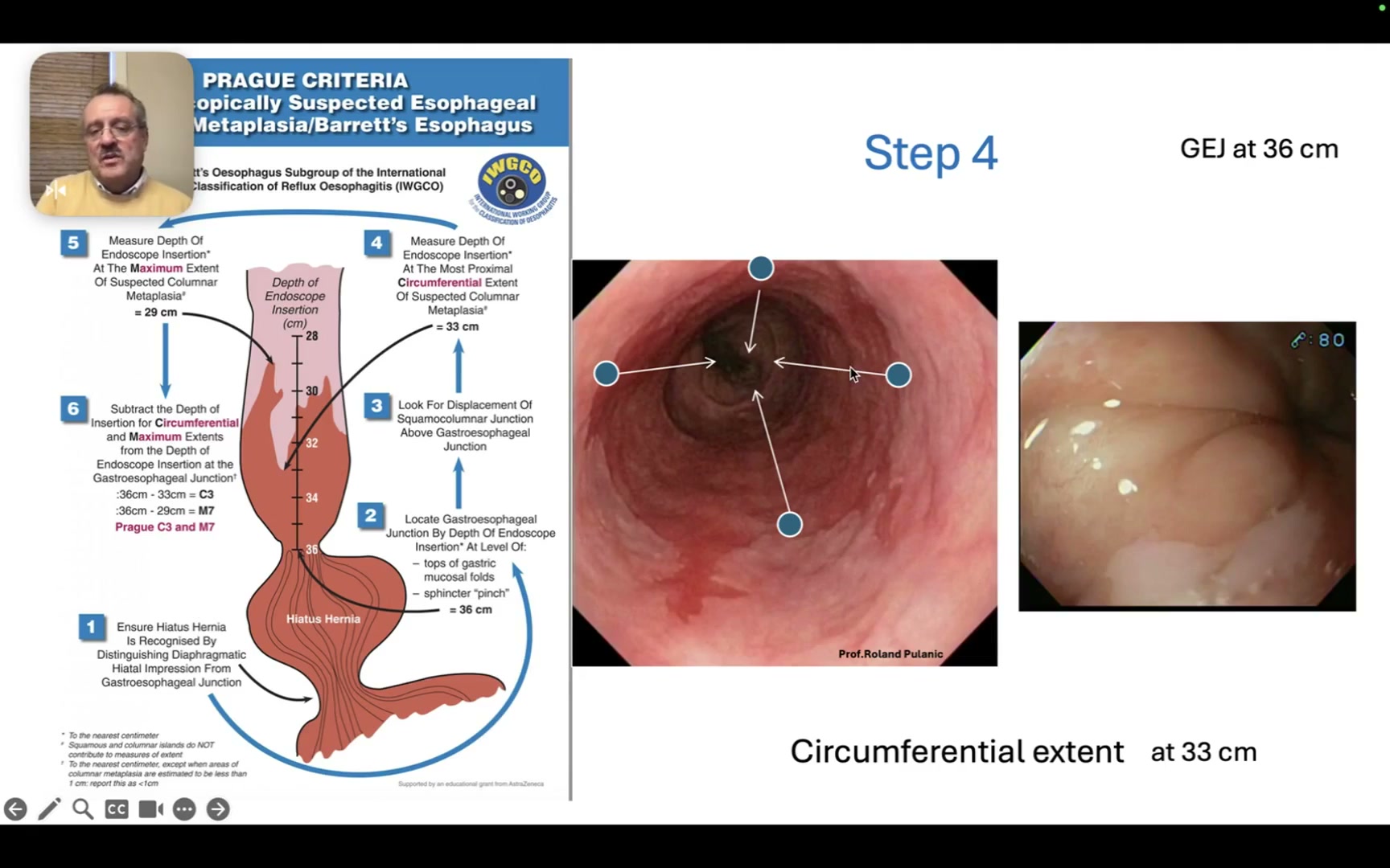 Prague C And M: A 7-Minute Barrett Length Guide 2 Gej At 36 Cm, Circumferential Extent At 33 Cm